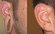 Earlobe Repair treatment