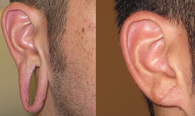 earlobe repair treatment