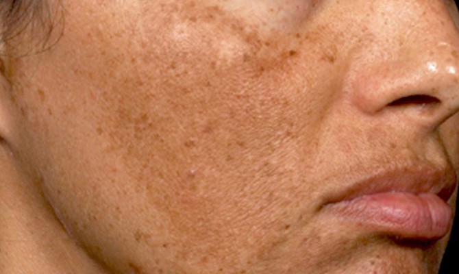 skin Pigmentation