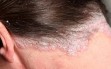 Scalp psoriasis