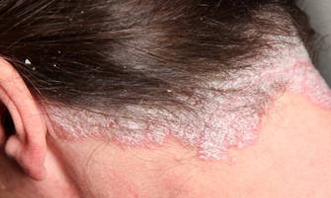 Scalp psoriasis