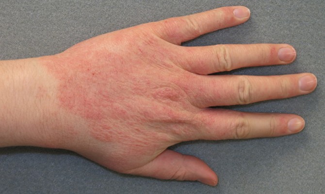 contact-dermatitis