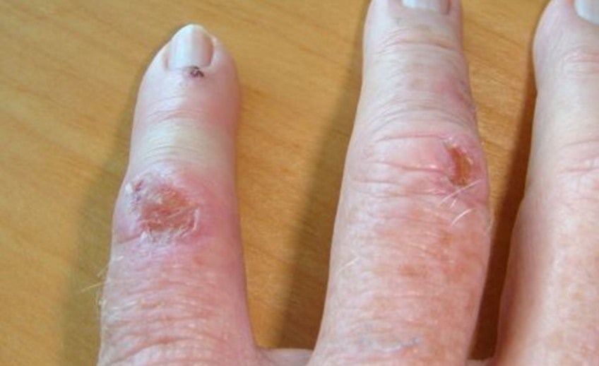 skin fungal infection