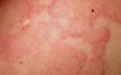 urticaria