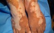 vitiligo