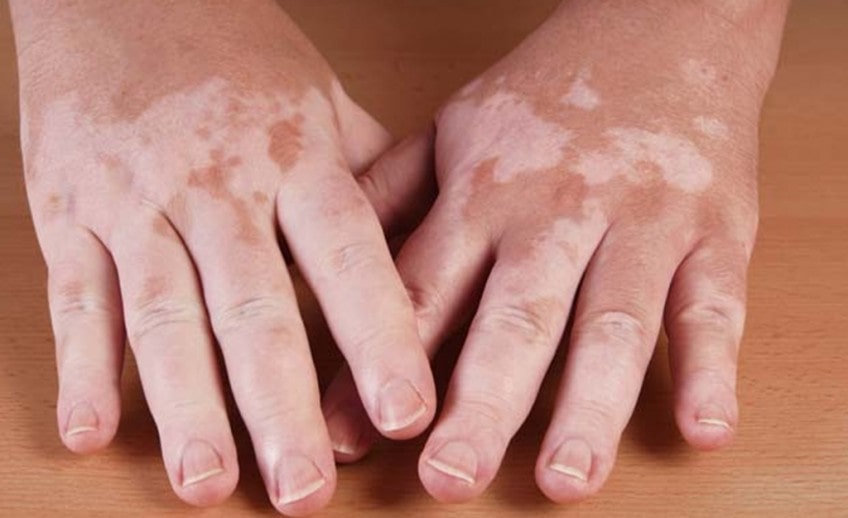 vitiligo treatment