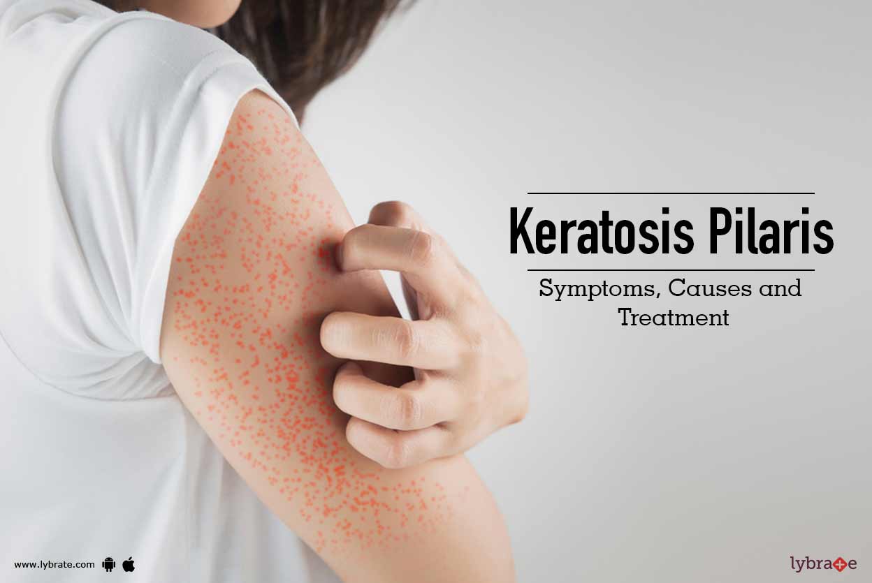 keratosis-pilaris-symptoms